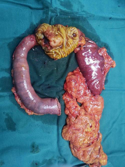 佳能医疗与奥林巴斯签约 将在胆胰疾病精准治疗领域开展战略合作