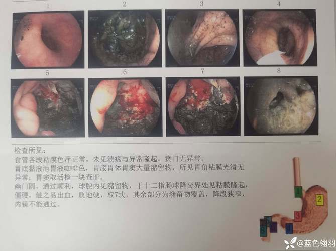 Novotech 发布胆囊癌临床试验全球综合情况报告