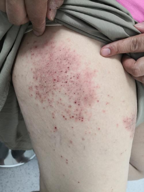 过敏季皮肤病易复发加重 特应性皮炎患者需重视长期管理